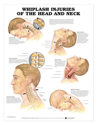 Whiplash Injuries of the Head & Neck Chart