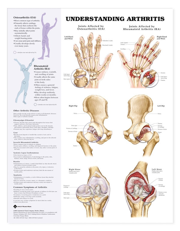 Understanding Arthritis Chart Medelco
