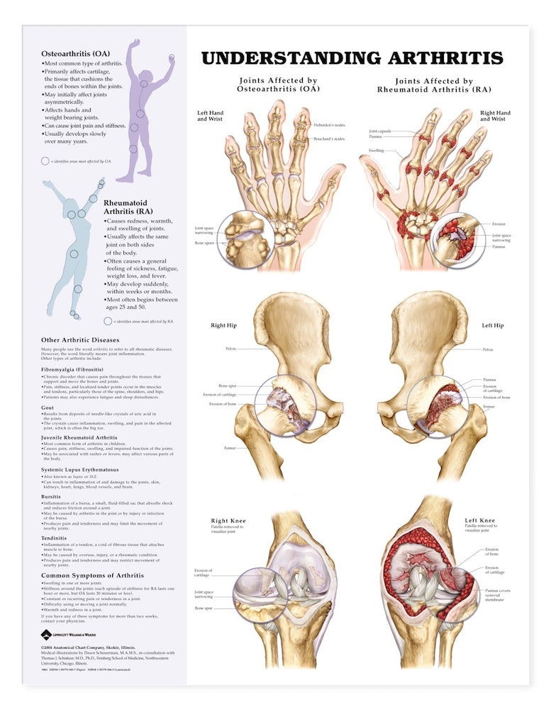 Understanding Arthritis Chart