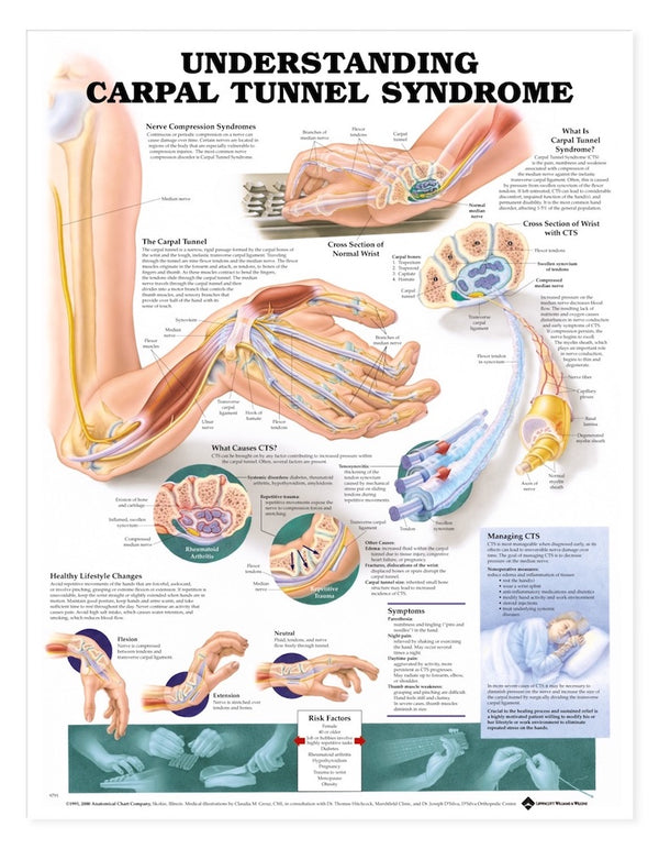 Understanding Carpal Tunnel Syndrome Chart