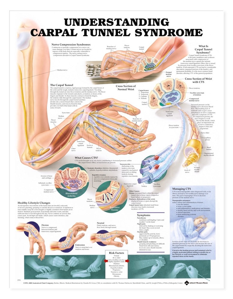 Understanding Carpal Tunnel Syndrome Chart – MEDELCO