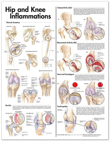 Hip & Knee Inflamations Chart